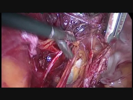 Left Ureterolysis