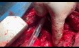 Patient with Tracheoinnominate Artery Fistula Repair