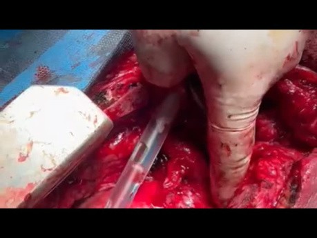 Patient with Tracheoinnominate Artery Fistula Repair