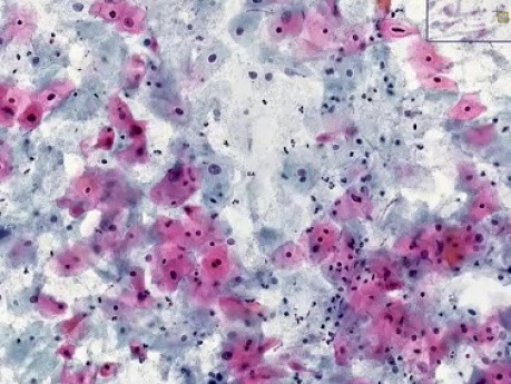High grade squamous intraepithelial - Histopathology - Cervix