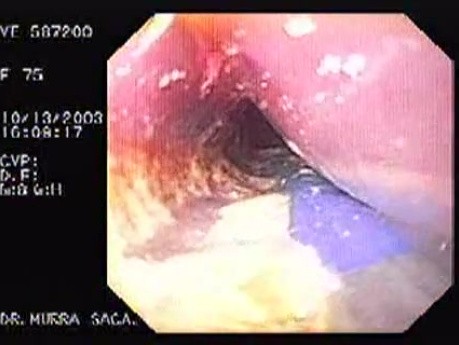 Esophageal Achalasia  (6 of 16)