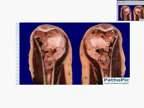 Bone - Osteosarcoma
