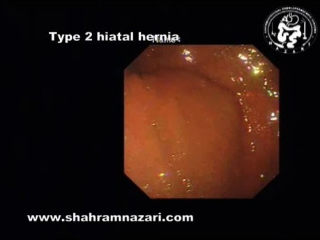 Type 2 Hiatal Hernia