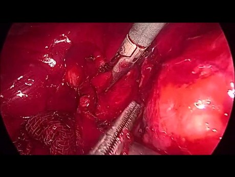 Laparoscopic Common Bile Duct Exploration. Bleeding from Supraduodenal Artery