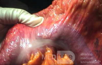 Endoscopic Image of Adenocarcinoma of the Transverse Colon (4 of 9)