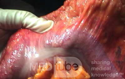 Endoscopic Image of Adenocarcinoma of the Transverse Colon (4 of 9)