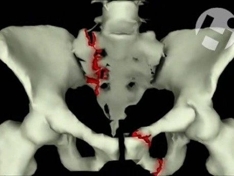 Volumated Pelvis