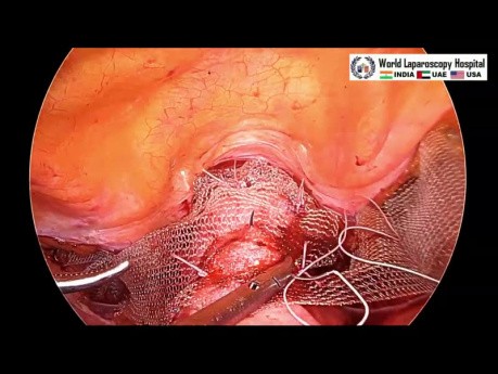 Laparoscopic Pectopexy