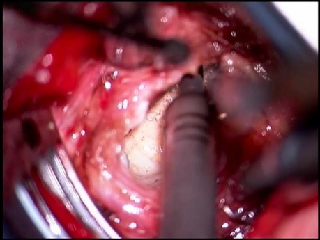Ventral Fusion with PEEK