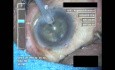 Cataract Surgery VII - Part 3