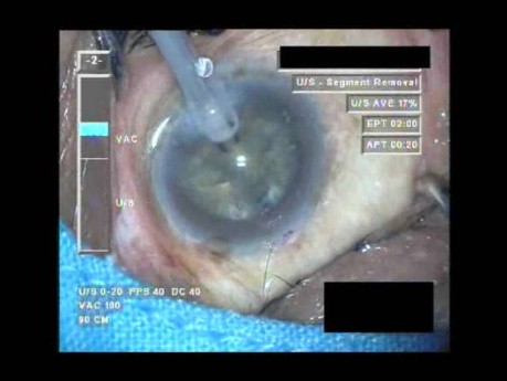 Cataract Surgery VII - Part 3