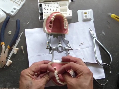 Molar Intrusion - Table Top How To - Part 2/2