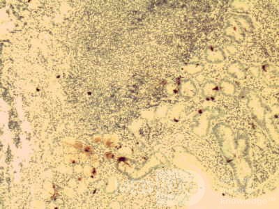 Gastric lymphoma with metastases to the duodenum (14 of 15)