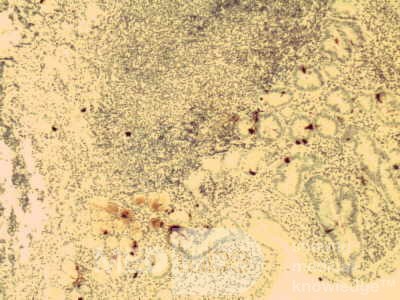Gastric lymphoma with metastases to the duodenum (14 of 15)