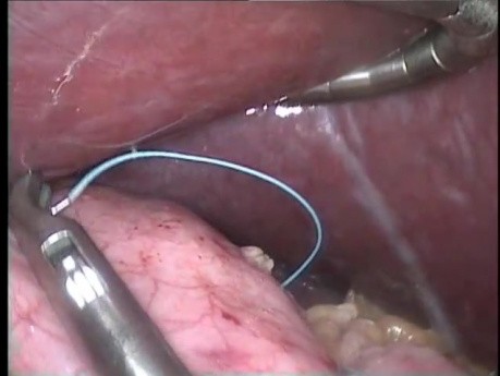 Laparoscopic Gastric Sleeve Plication of Greater Curvature
