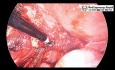 Ovarian Endometrioma Ablation for Preservation of the Ovarian Parenchyma