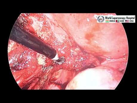 Ovarian Endometrioma Ablation for Preservation of the Ovarian Parenchyma