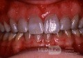 Tetracycline Staining of Teeth