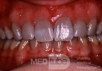 Tetracycline Staining of Teeth