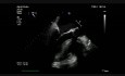 Aortic Bioprothesis Infective Endocarditis