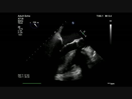 Aortic Bioprothesis Infective Endocarditis
