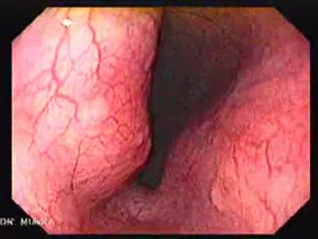 Gastrointestinal Stromal Tumors - Presence of the Tumor