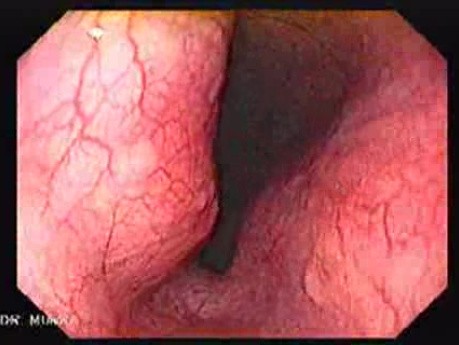 Gastrointestinal Stromal Tumors - Presence of the Tumor