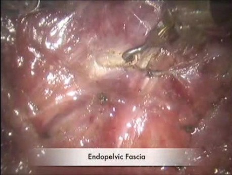 Robotic Cylindrical Abdominoperineal Resection With Transabdominal Levator Transection
