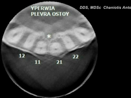 CBVT application in lateral luxation injuries (HD)