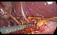 Common Bile Duct Stones - Laparoscopic Treatment