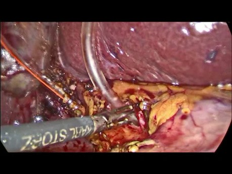 Common Bile Duct Stones - Laparoscopic Treatment