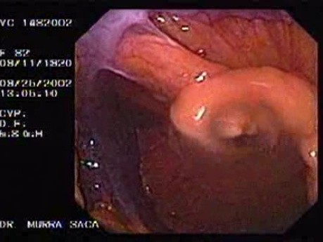 Colon Sigmoid Perforation (1 of 4)