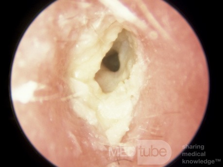 Chronic Otitis Externa Showing Large Sheets of Unseparated Keratin Squanes
