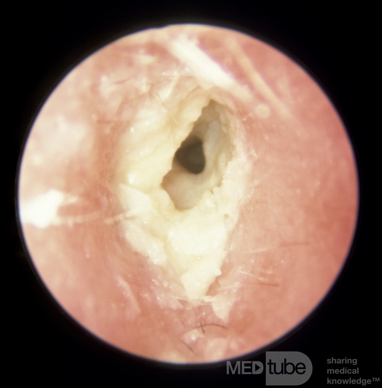 Chronic Otitis Externa Showing Large Sheets of Unseparated Keratin Squanes