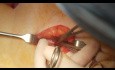 Sigmoid Loop Colostomy