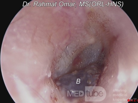 Haemorrhagic Bullous Myringitis