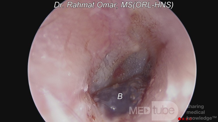 Haemorrhagic Bullous Myringitis
