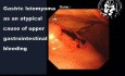 Gastric Leiomyoma as an Atypical Cause of Upper Gastrointestinal Bleeding
