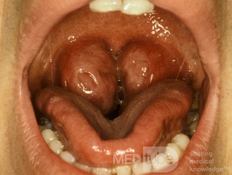 Massively Enlarged Tonsils
