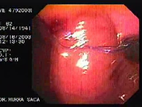 Intraluminal Endoscopic Suturing - Creation of the First Gastroplicature