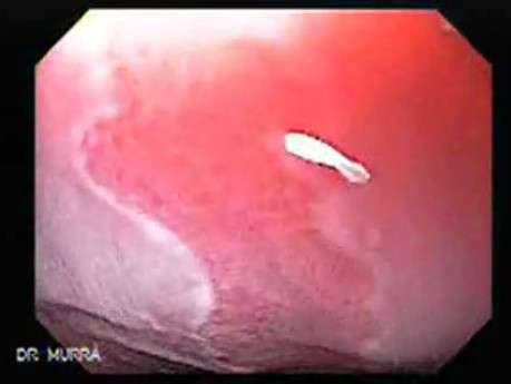 Barrett Esophagus - endoscopic view  (4 of 9)