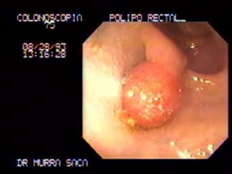 Pediculated Tubular Adenoma