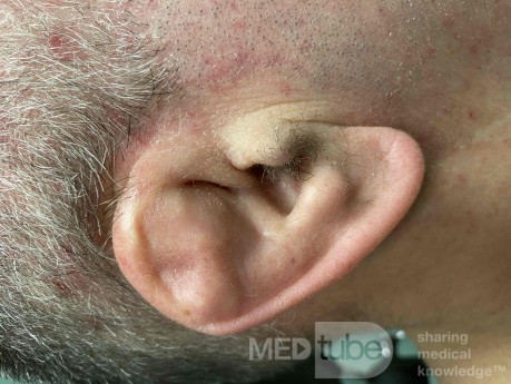 Cauliflower Ear