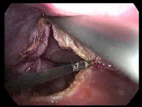 Laparoscopic deroofing of simple liver cyst