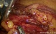 Advanced Sigmoid Colon Cancer Surgical Treatment