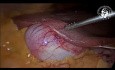 Aberrant Liver Tissue on Gallbladder Surface