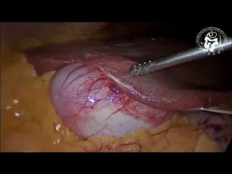 Aberrant Liver Tissue on Gallbladder Surface