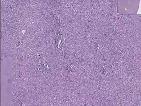 Cytomegalic inclusion disease (CMV)