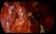 Laparoscopic Spleen Preserving Distal Pancreatectomy for Spt With Bleeding From Splenic Vein