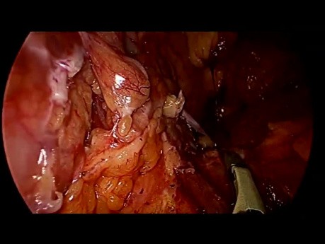 Laparoscopic Spleen Preserving Distal Pancreatectomy for Spt With Bleeding From Splenic Vein